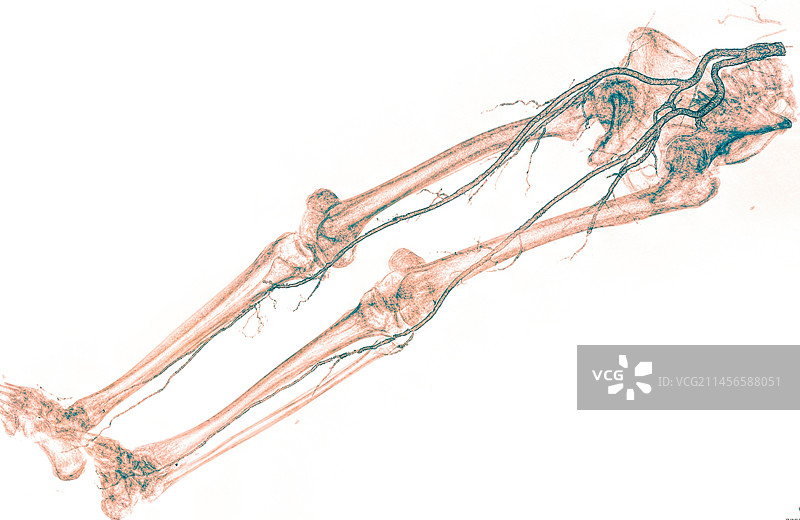动脉粥样硬化，CT扫描图片素材