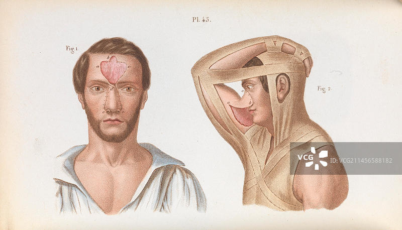 鼻部整形手术插图图片素材