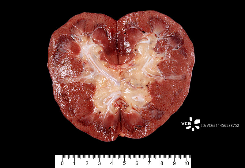 人类肾脏图片素材