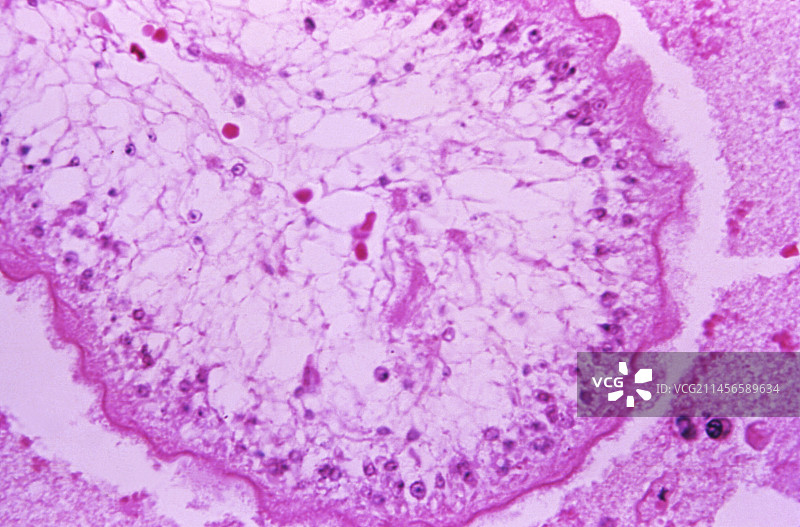 脑囊虫病的光学显微照片图片素材