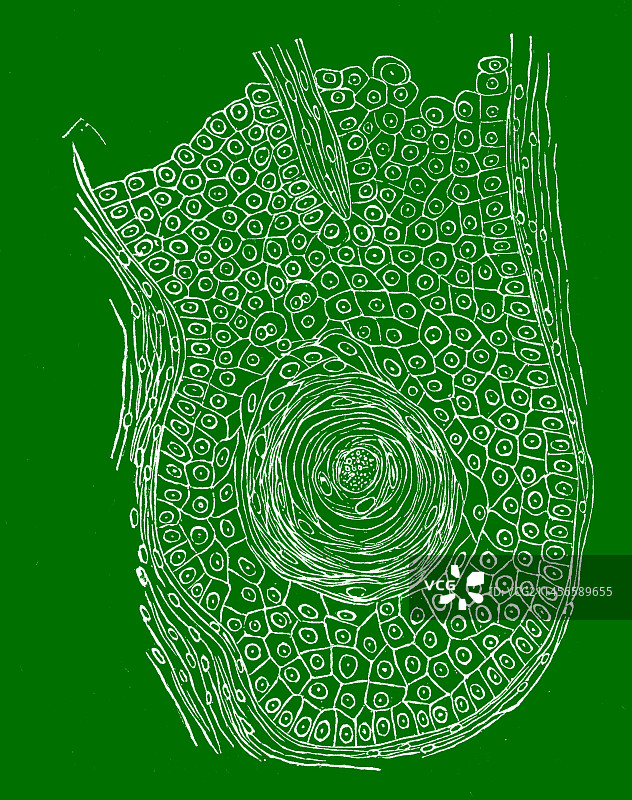 鳞状细胞癌19世纪插图图片素材