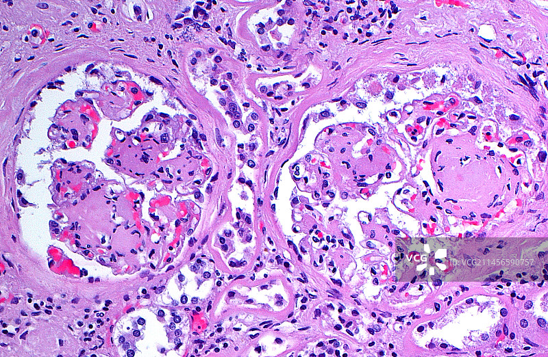 糖尿病肾病：光学显微照片图片素材