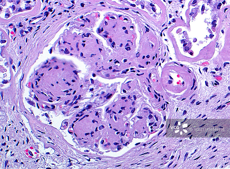 糖尿病肾病：光学显微照片图片素材
