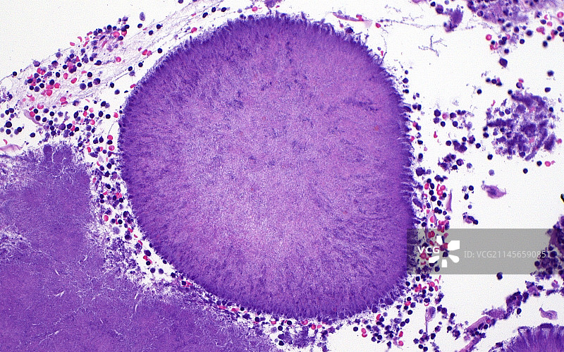 扁桃体中的细菌，光学显微照片图片素材