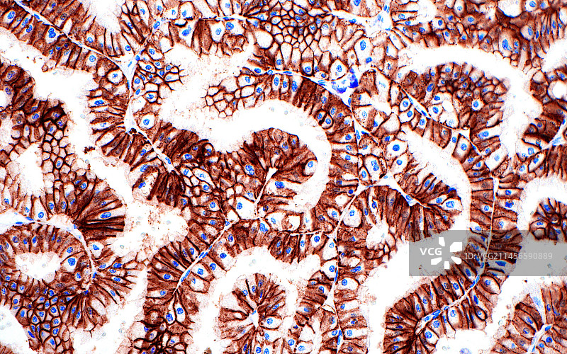 肾癌光学显微照片图片素材