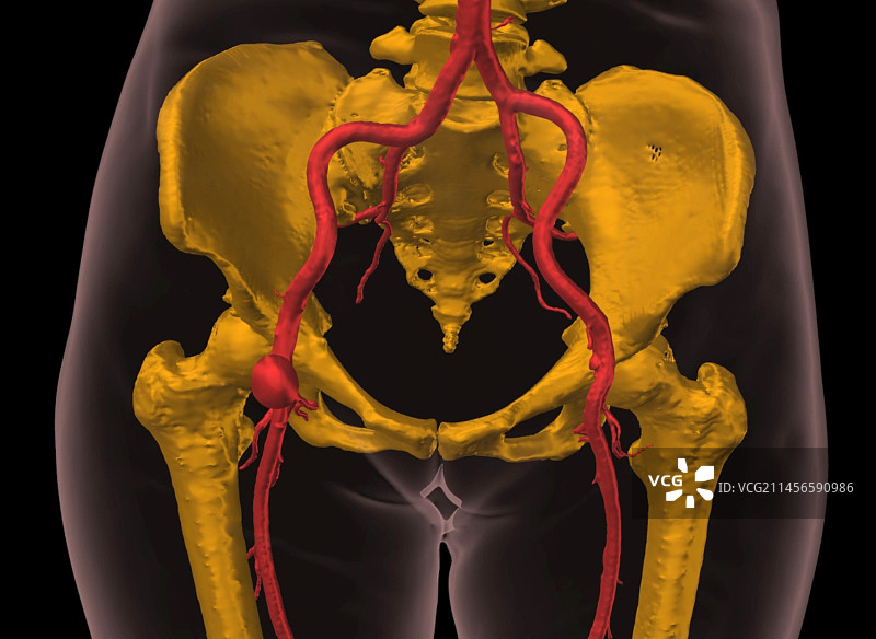 股动脉假性动脉瘤3D CT扫描图片素材