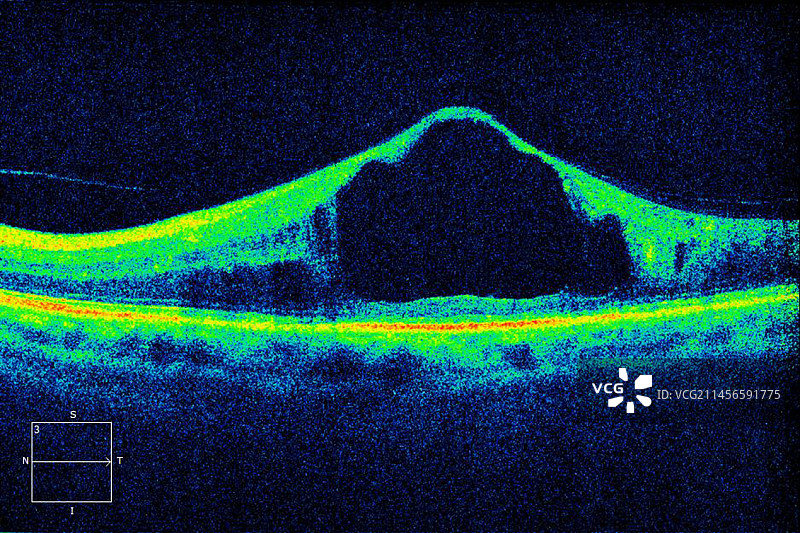 糖尿病黄斑水肿OCT扫描图片素材