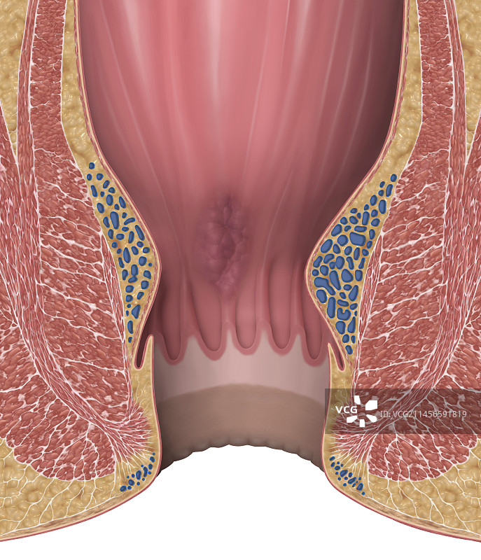 1级痔疮插图图片素材