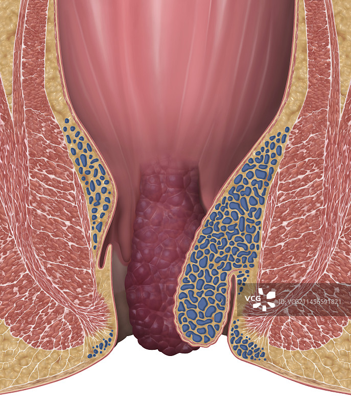 3级痔疮插图图片素材