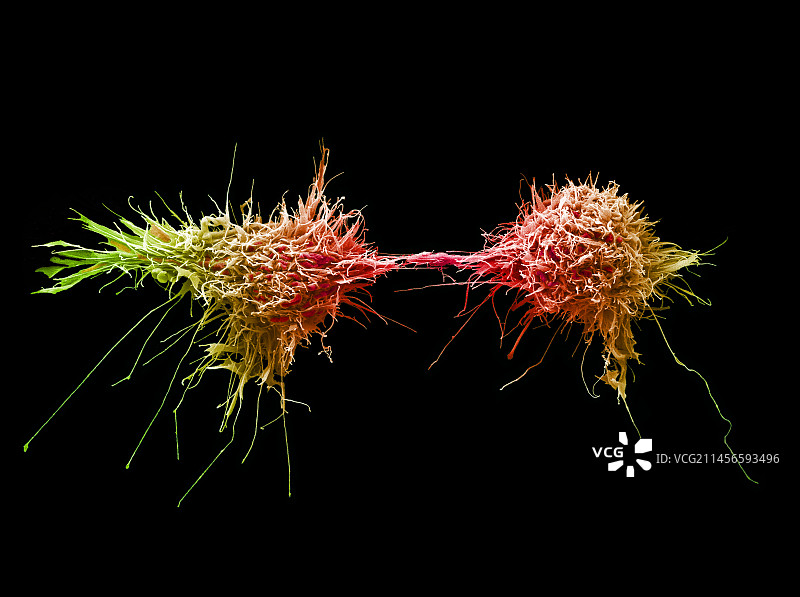 宫颈癌细胞分裂，扫描电镜图片素材