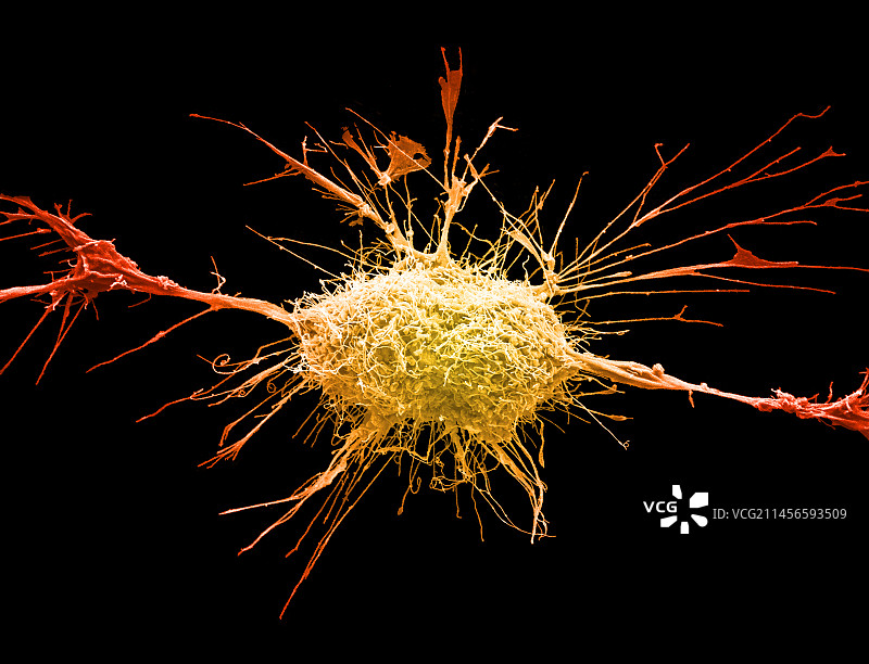 宫颈癌细胞扫描电镜图图片素材