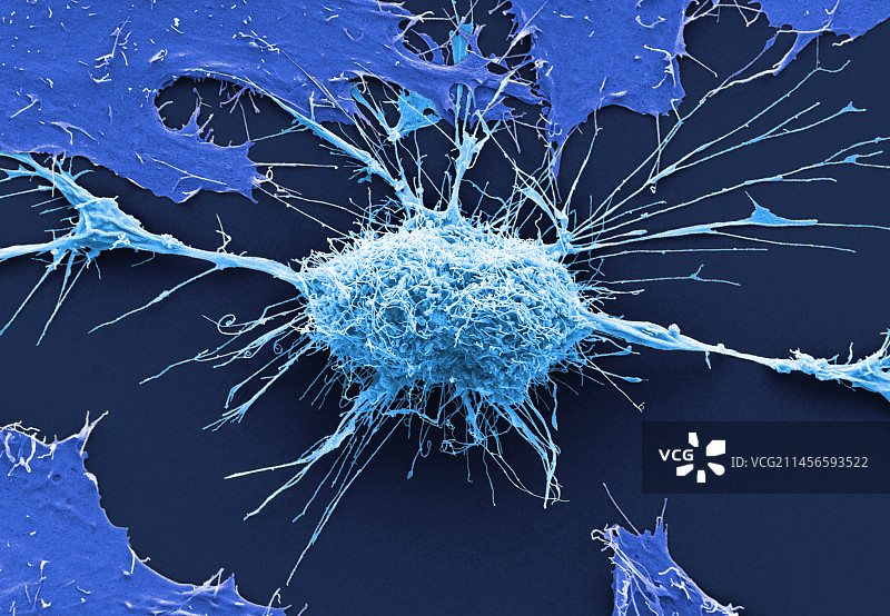 宫颈癌细胞，扫描电子显微镜图片素材