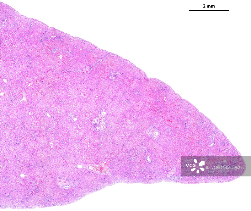 肝纤维化浅显缩略图图片素材