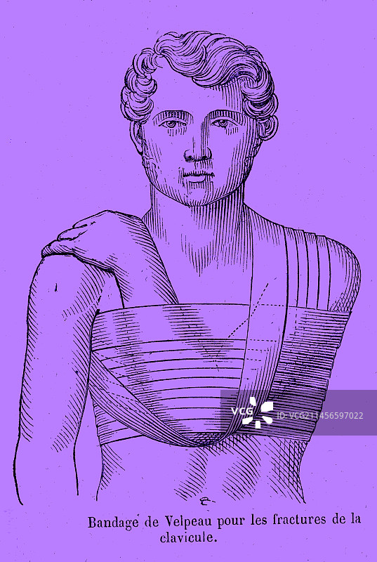 Velpeau绷带，插图图片素材