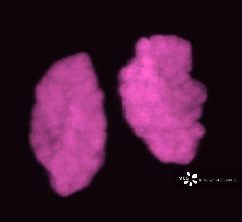 末期的人类染色体，光学显微照片图片素材