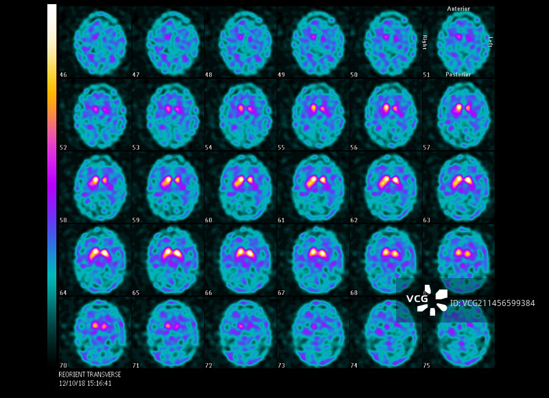 多巴胺转运蛋白PET脑部扫描图片素材