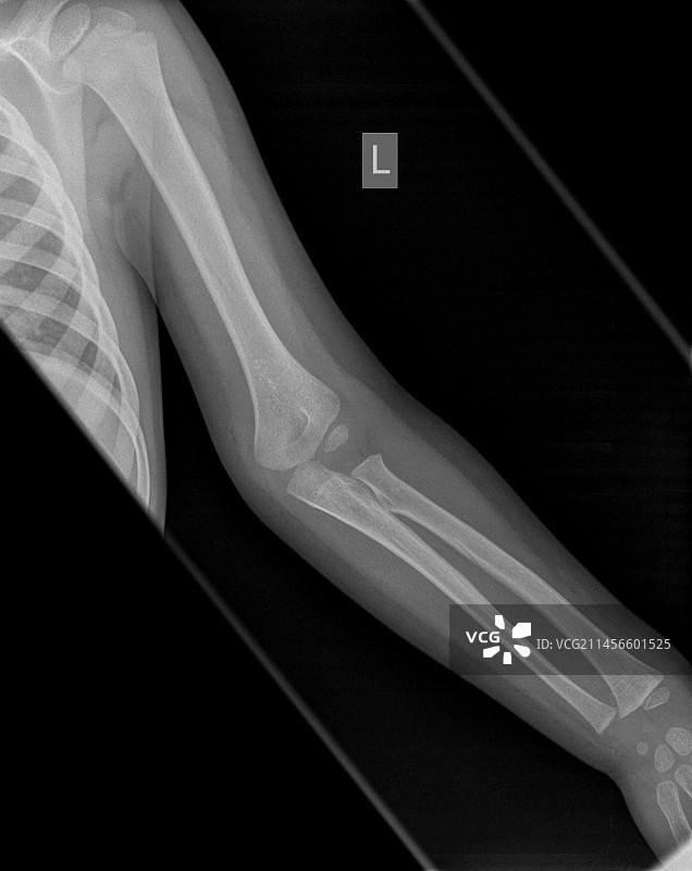 肱骨髁上骨折X光片图片素材