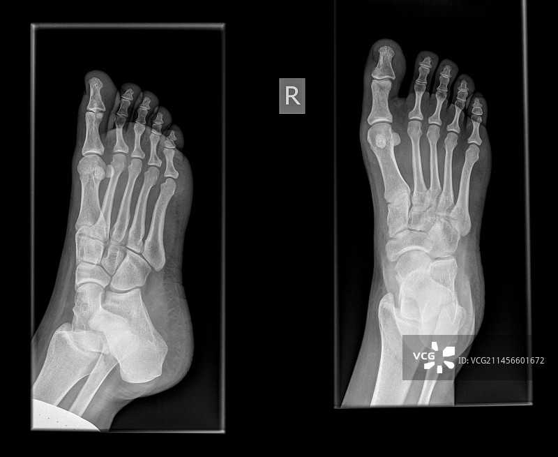 脚趾骨折X光片图片素材