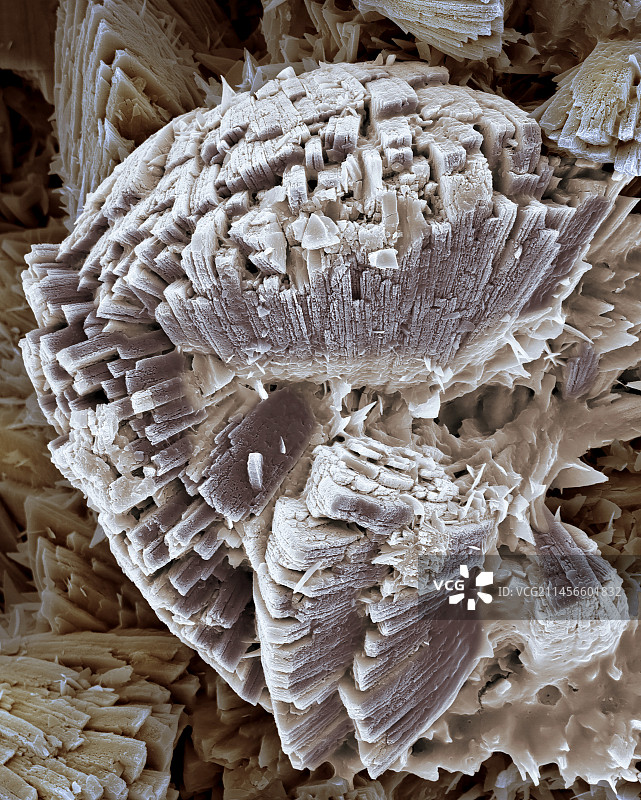 肾结石，扫描电镜图片素材