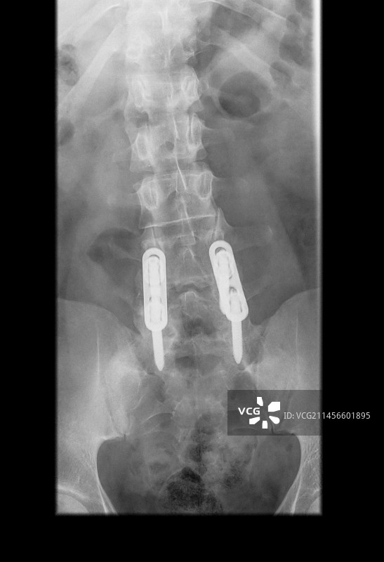 腰椎螺钉X光片图片素材