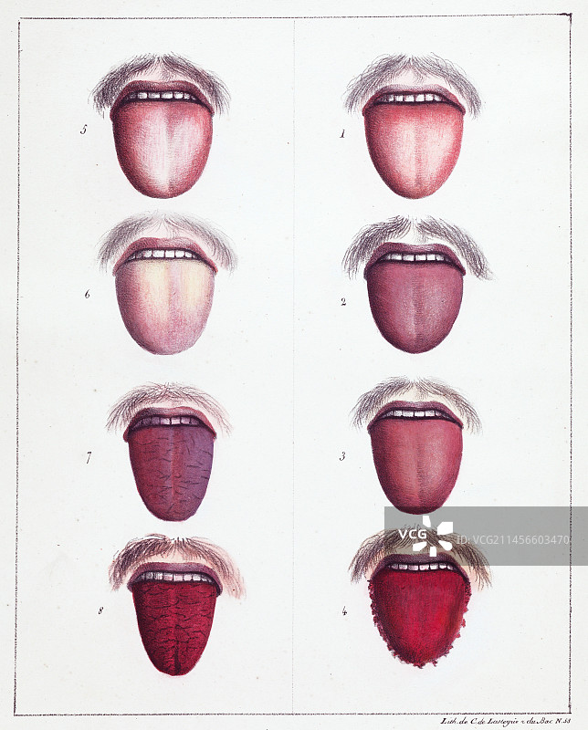 19世纪的黄热病症状图图片素材