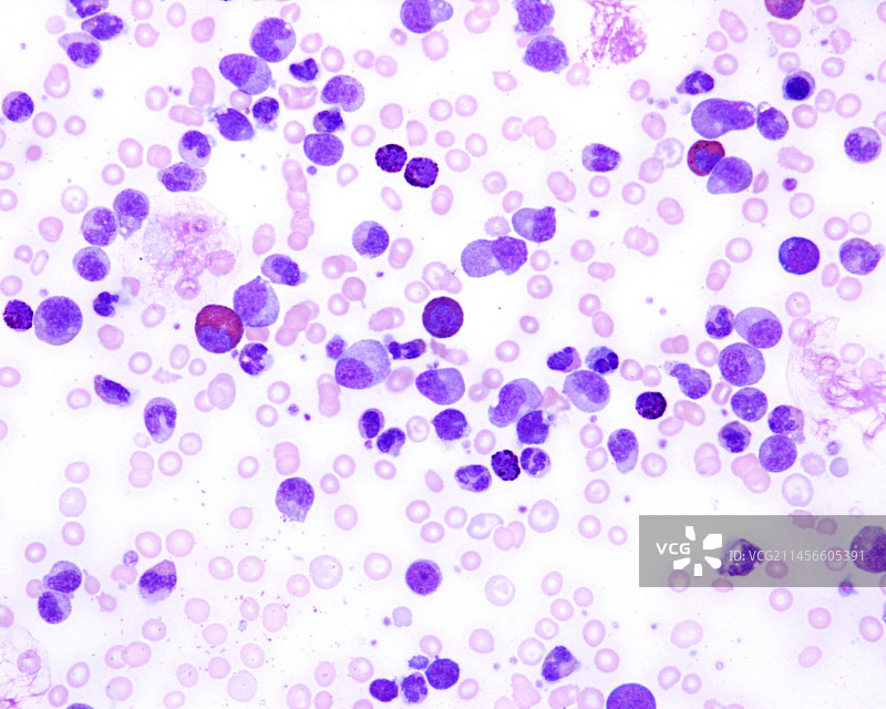 慢性粒细胞白血病显微照片图片素材