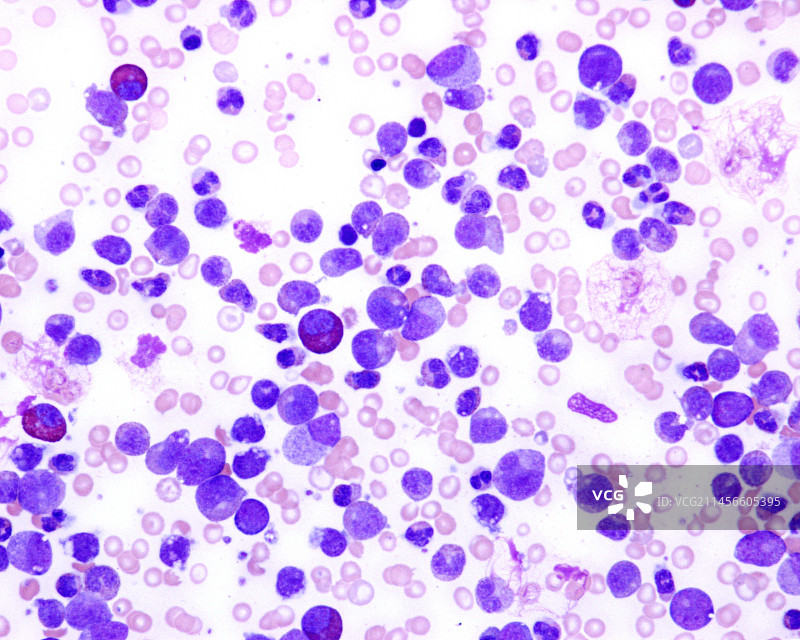 慢性粒细胞白血病显微照片图片素材