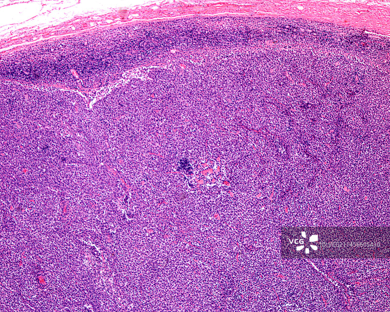 淋巴结网状细胞肉瘤显微照片图片素材
