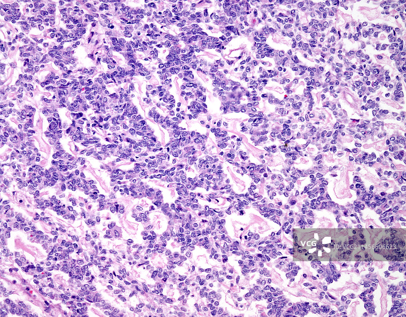 肾脏透明细胞肉瘤显微照片图片素材