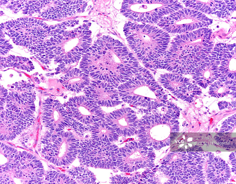 肾母细胞瘤显微照片图片素材
