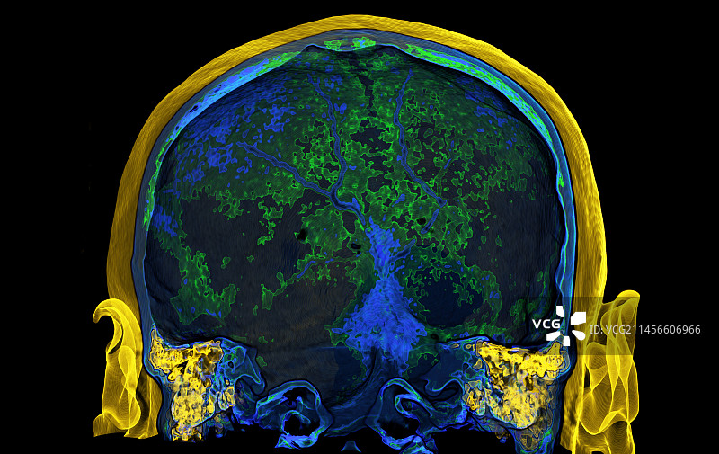人耳3D CT扫描图片素材
