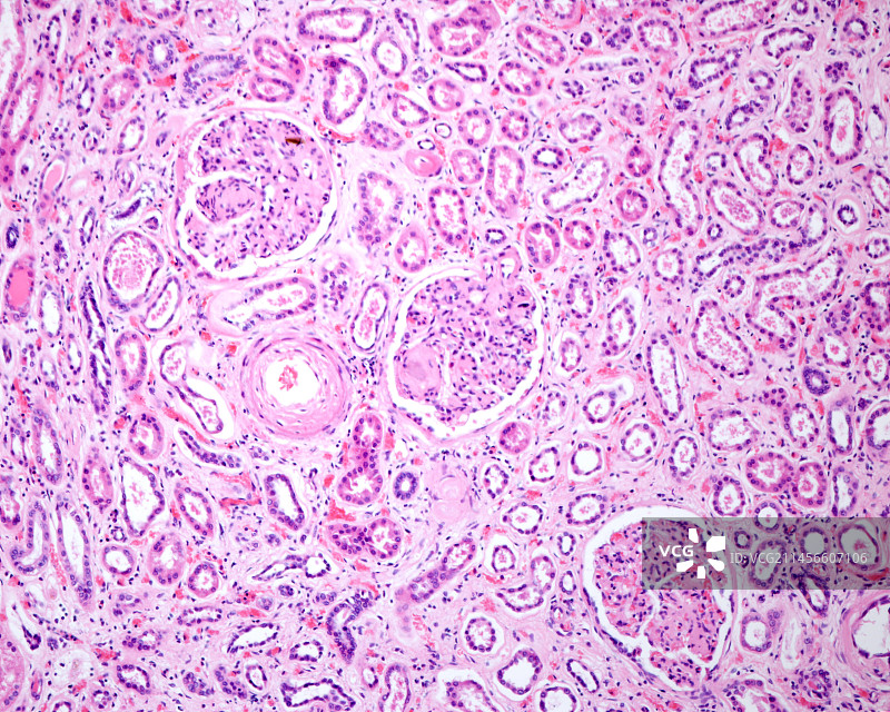 糖尿病肾病光学显微照片图片素材