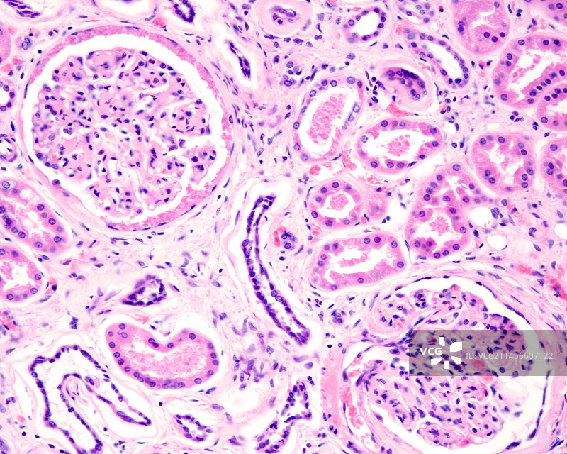 糖尿病肾病光学显微照片图片素材