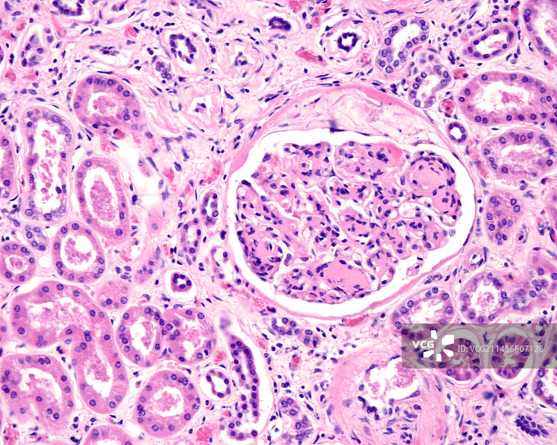 糖尿病肾病光学显微照片图片素材