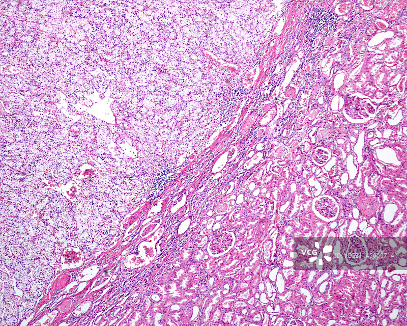透明细胞肾细胞癌显微照片图片素材