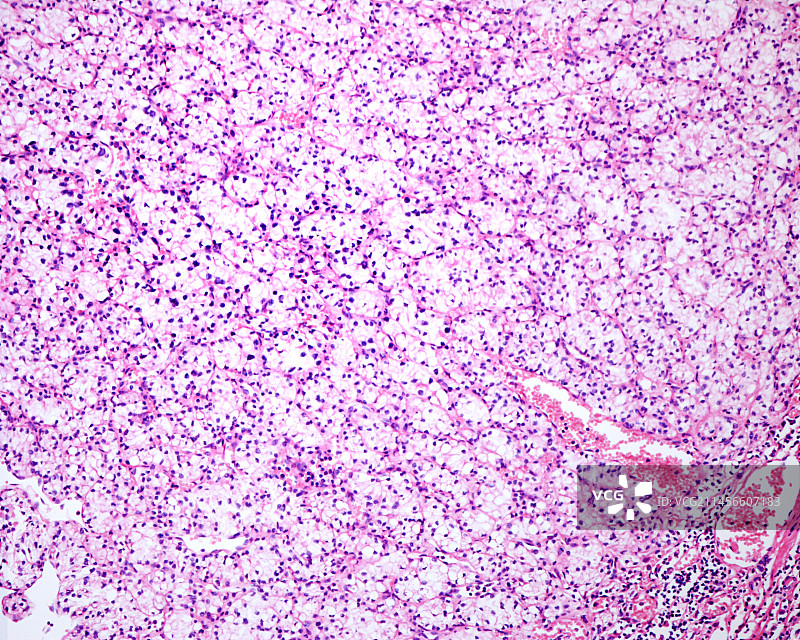 透明细胞肾细胞癌显微照片图片素材