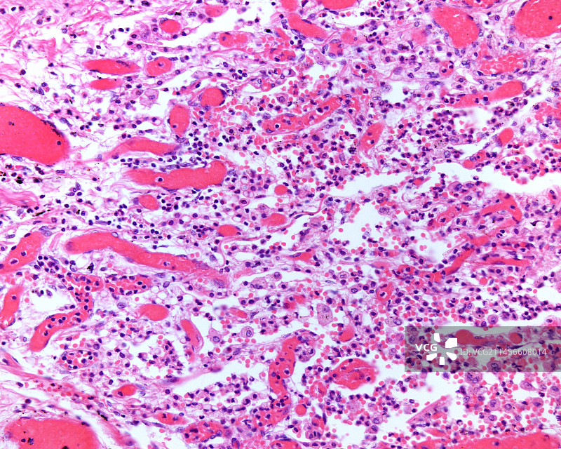 发炎的结缔组织显微照片图片素材