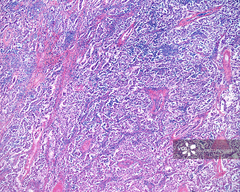 睾丸癌显微照片图片素材