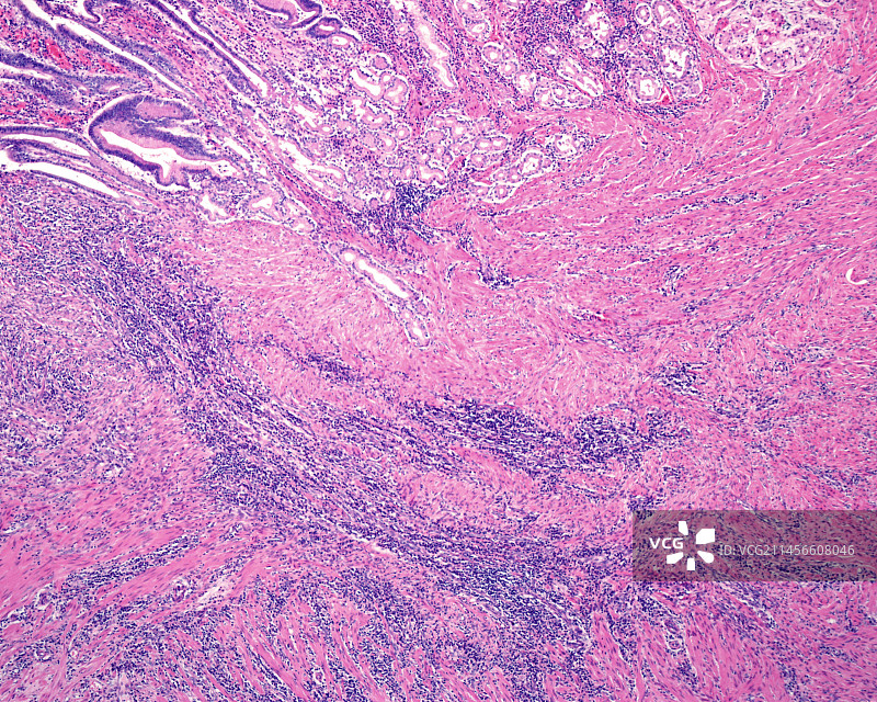 消化性溃疡显微照片图片素材