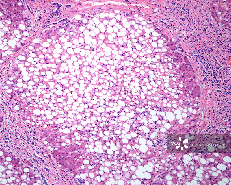 肝硬化和脂肪变性，光学显微照片图片素材