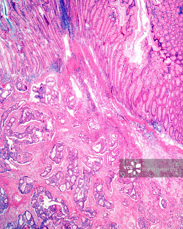 人结肠腺癌光学显微照片图片素材