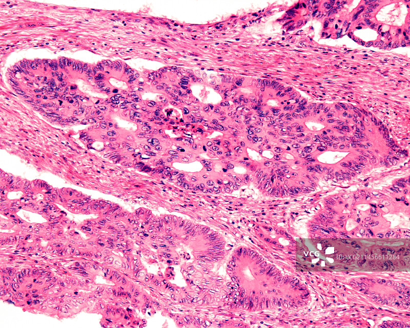 人结肠腺癌光学显微照片图片素材