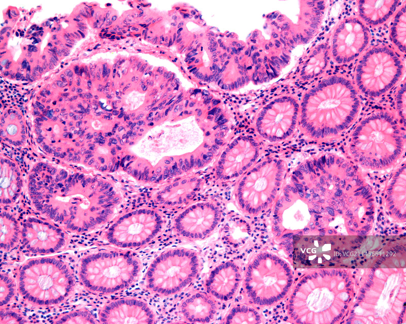 人结肠腺癌光学显微照片图片素材
