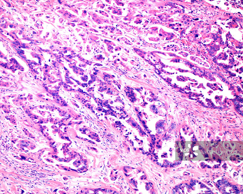 卵巢黏液性囊腺癌显微照片图片素材