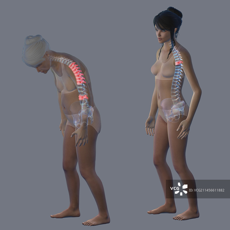 骨质疏松症，图示图片素材