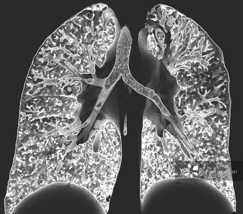 支气管扩张3D CT扫描图片素材