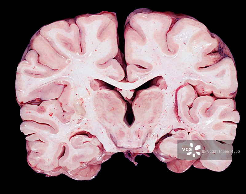 人脑，肉眼标本图片素材