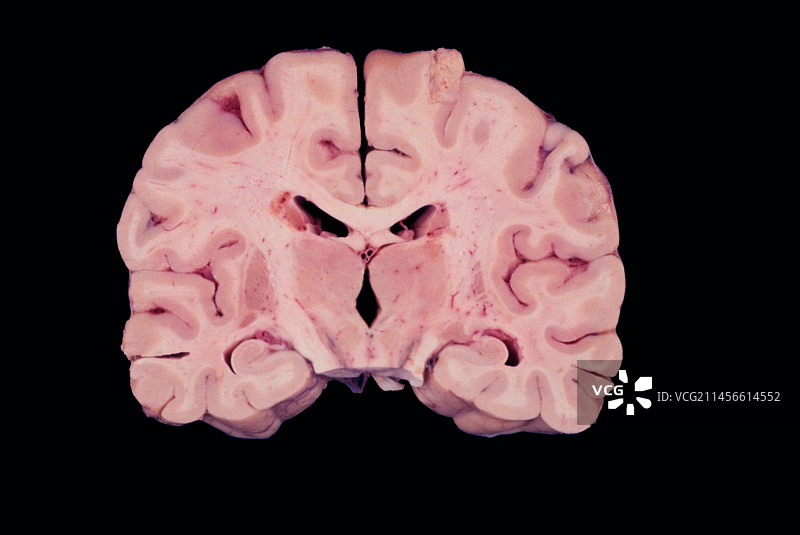 人脑，肉眼标本图片素材