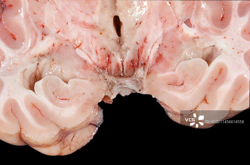 人脑，肉眼标本图片素材