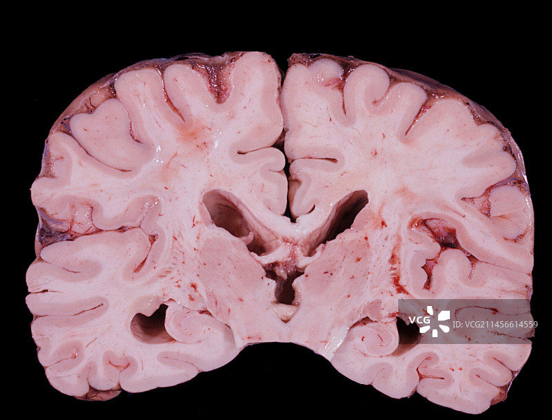 人脑，肉眼标本图片素材